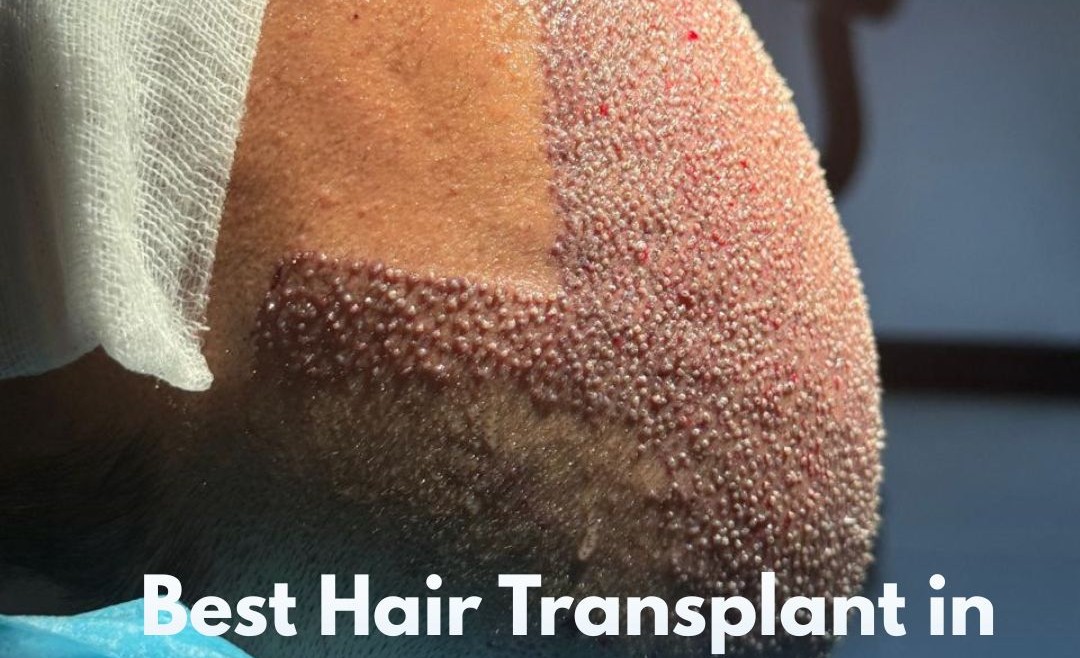 Best Hair Transplant in Islamabad Pakistan