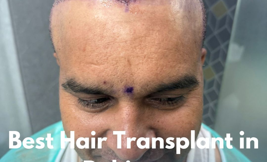 Best Hair Transplant in Pakistan