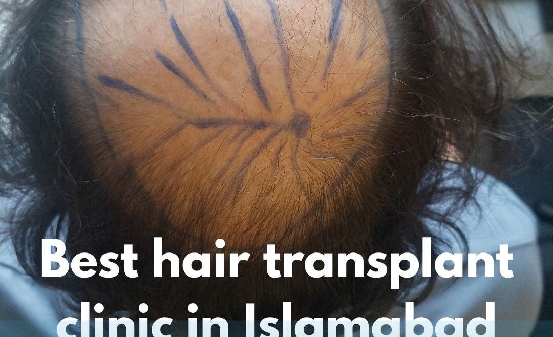 Best hair transplant clinic in Islamabad