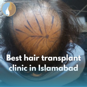Best hair transplant clinic in Islamabad