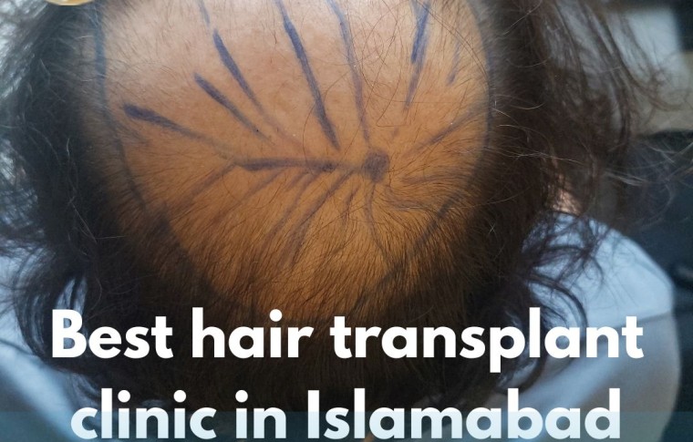 Best hair transplant clinic in Islamabad
