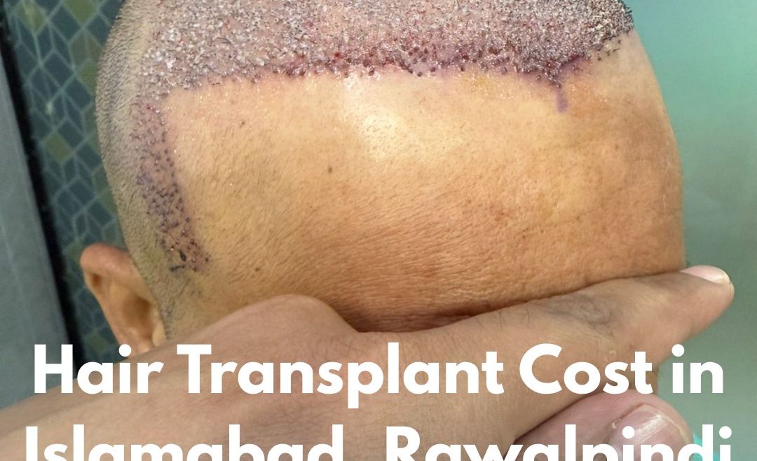 Best Hair Transplant in Islamabad Price