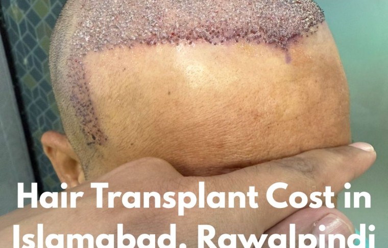 Best Hair Transplant in Islamabad Price