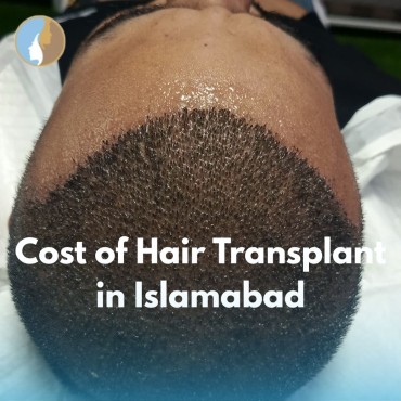 Cost of Hair Transplant in Islamabad