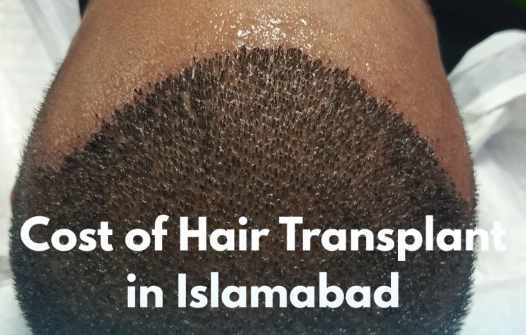 Cost of Hair Transplant in Islamabad