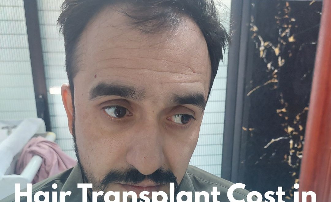 Hair Transplant Cost in Islamabad, Rawalpindi