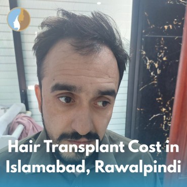 Hair Transplant Cost in Islamabad, Rawalpindi