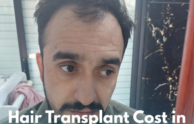 Hair Transplant Cost in Islamabad, Rawalpindi