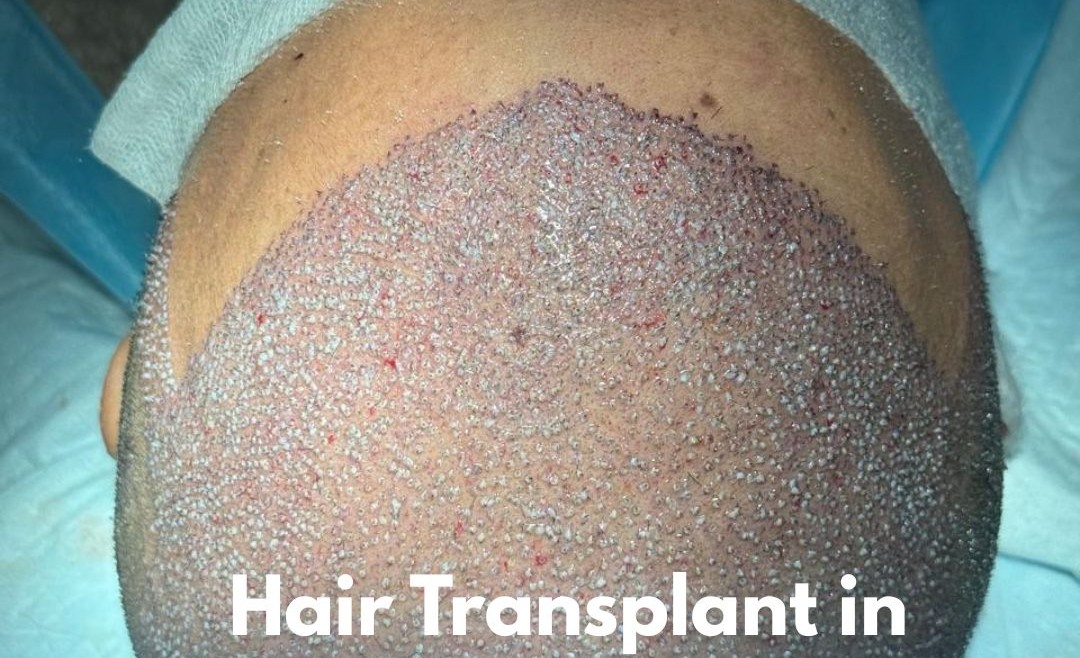 Hair Transplant in Pakistan Islamabad Cost