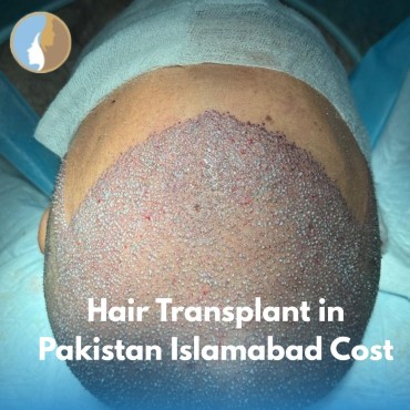 Hair Transplant in Pakistan Islamabad Cost