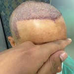 Hair Transplant in Islamabad