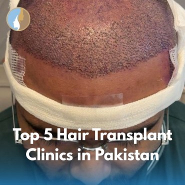Top 5 Hair Transplant Clinics in Pakistan