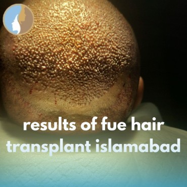 Results of FUE hair transplant Islamabad