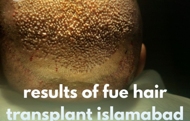 Results of FUE hair transplant Islamabad