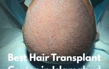 Best Hair Transplant Center in Islamabad