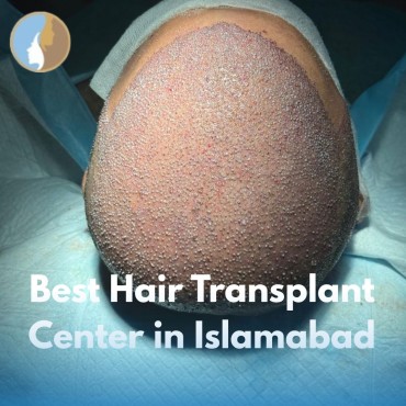 Best Hair Transplant Center in Islamabad