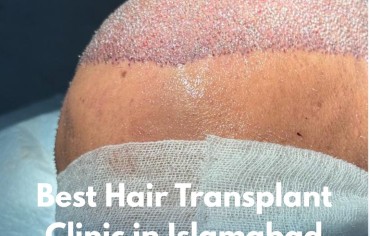 Best Hair Transplant Clinic in Islamabad