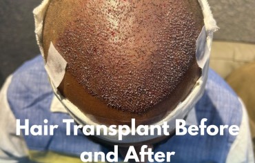 Hair Transplant Before and After