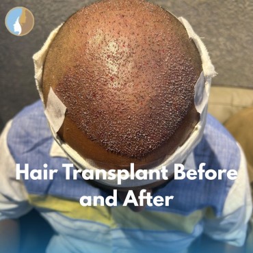 Hair Transplant Before and After