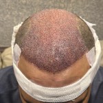 The best Hair Transplant in Islamabad Pakistan - The Capital Aesthetic