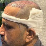 Hairline Transplant in Islamabad