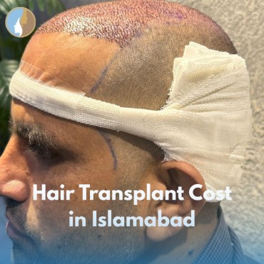 Hair Transplant Cost in Islamabad