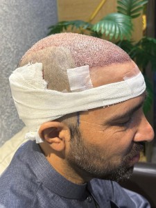 Hair Transplant in Islamabad Pakistan