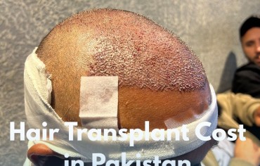 Hair Transplant Cost in Pakistan