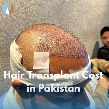 Hair Transplant Cost in Pakistan